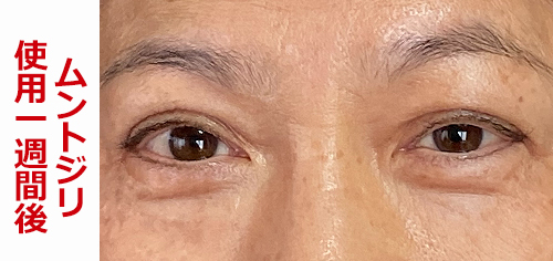 眼瞼下垂効果-1週間使用後